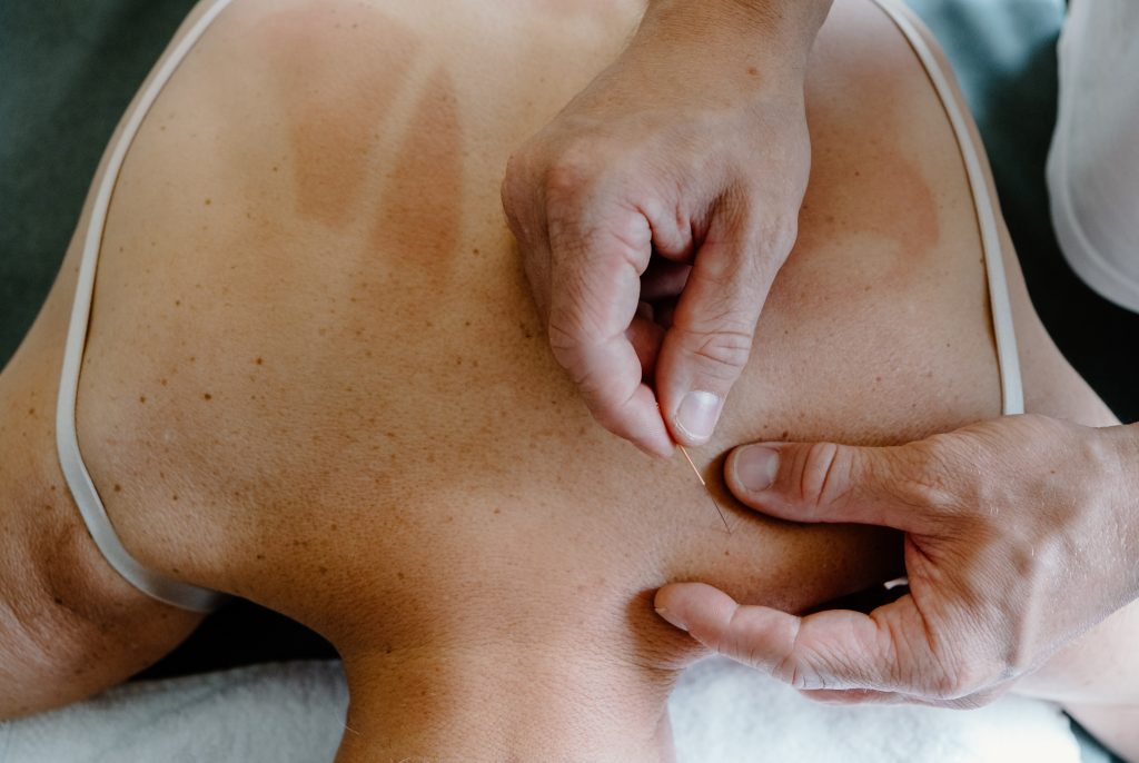 kine gent dry needling
