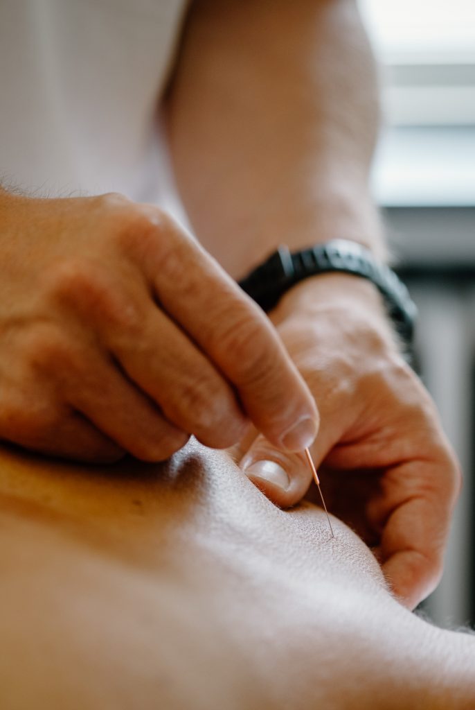 kine gent dry needling